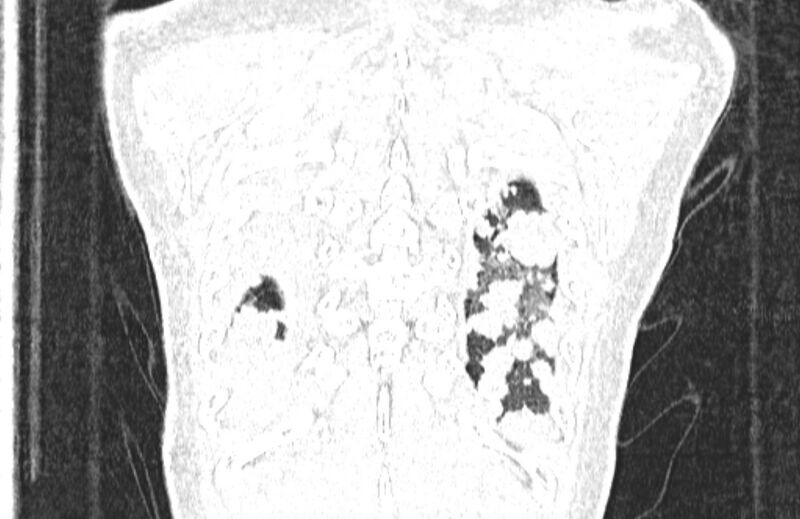 File:Cannonball metastases from breast cancer (Radiopaedia 91024-108569 Coronal lung window 134).jpg