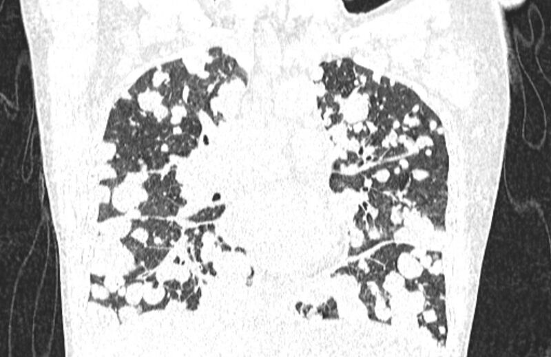 File:Cannonball metastases from breast cancer (Radiopaedia 91024-108569 Coronal lung window 71).jpg