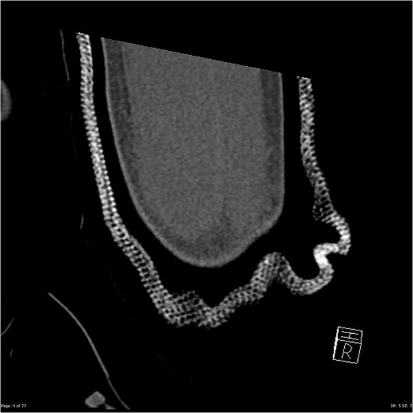 File:Capitellum fracture (Radiopaedia 23352-23426 Coronal bone window 4).jpg