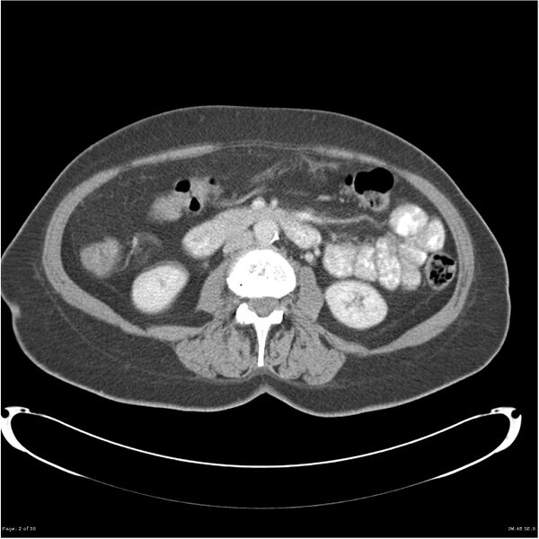 File:Carcinoid tumor of the ileum with metastasis to orbit (Radiopaedia 28165-28425 A 2).jpg