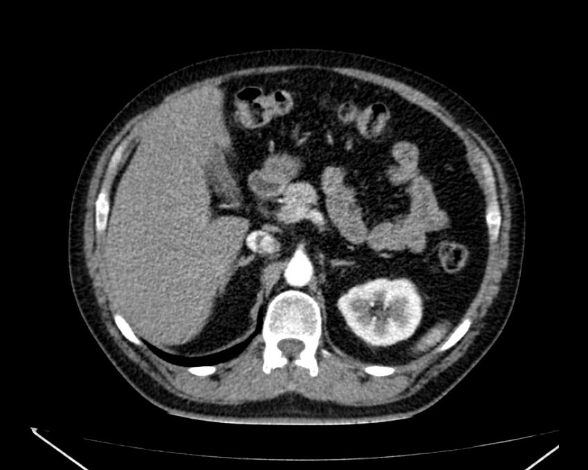 Carcinoid tumor with hepatic metastases (Radiopaedia 22651-22670 B 28).jpg