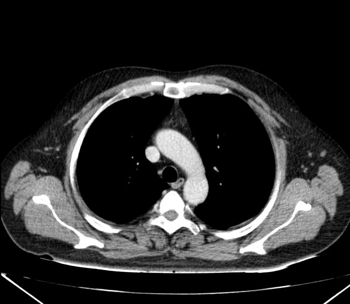 File:Carcinoid tumor with hepatic metastases (Radiopaedia 22651-22670 C 10).jpg
