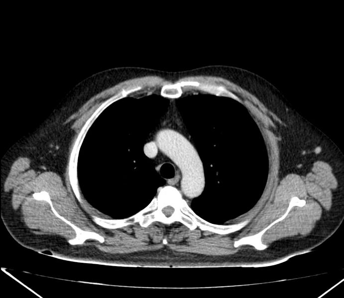 File:Carcinoid tumor with hepatic metastases (Radiopaedia 22651-22670 C 9).jpg