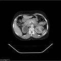 Carcinoma cervix- recurrence (Radiopaedia 34702-36137 B 16).jpg