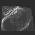 Cardiac fibroma (Radiopaedia 38974-41150 4 chamber FGRET 24).jpg