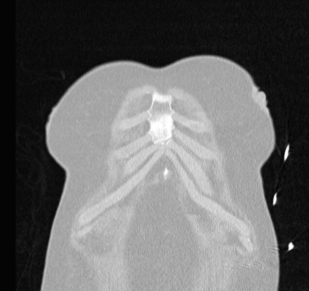 File:Cardiogenic pulmonary edema (Radiopaedia 29213-29609 Coronal lung window 3).jpg