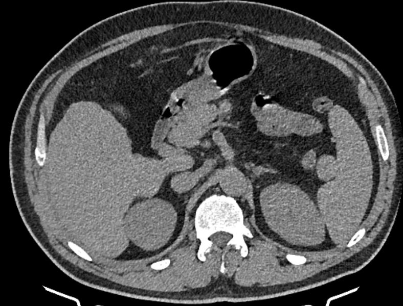File:Cardiogenic pulmonary edema (Radiopaedia 68180-77678 Axial non-contrast 68).jpg