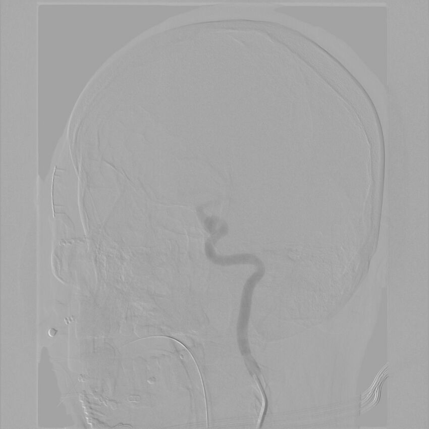 Caroticocavernous fistula - direct (Radiopaedia 61660-69666 Oblique Left ICA 12).jpg