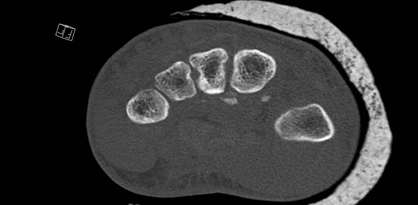 Carpal fractures (smart watch impaction) (Radiopaedia 55844-62430 Axial bone window 44).jpg