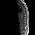 Caudal regression syndrome (Radiopaedia 61990-70072 Sagittal T1 6).jpg