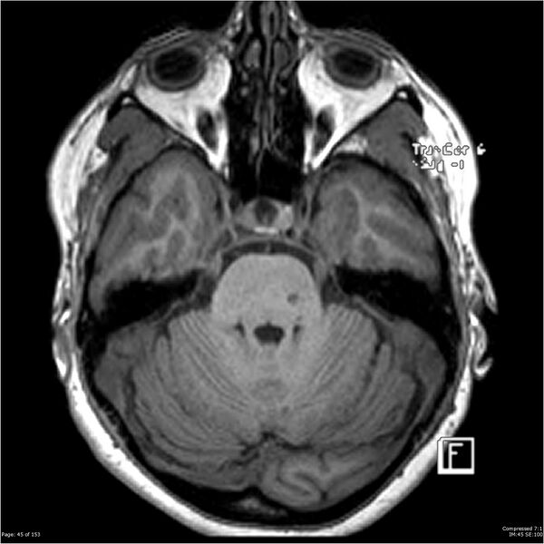 File:Cavernous malformation (cavernous angioma or cavernoma) (Radiopaedia 36675-38237 Axial T1 34).jpg