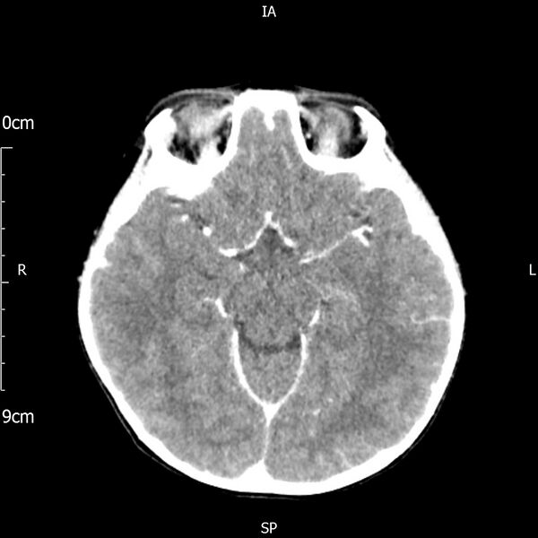 File:Cavernous sinus thrombosis (Radiopaedia 79414-92510 Axial Brain 92).jpg