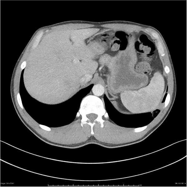 File:Cavitating lung cancer (Radiopaedia 25796-25945 C+ arterial phase 58).jpg