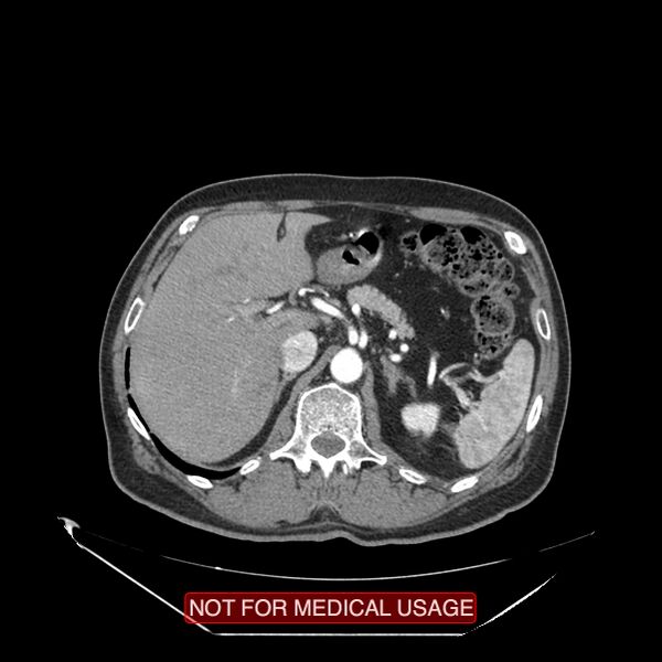 File:Celiac trunk variant anatomy - gastrohepatic trunk and splenic artery (Radiopaedia 38815-40995 A 17).jpg