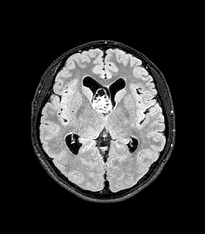 Central neurocytoma (Radiopaedia 79320-92380 Axial FLAIR 164).jpg