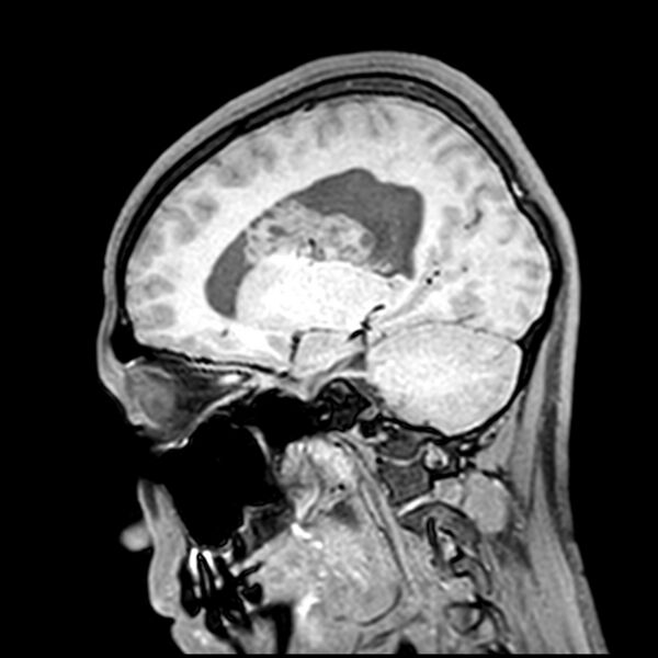 File:Central neurocytoma (Radiopaedia 79320-92380 Sagittal T1 162).jpg