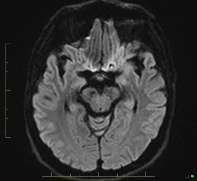 File:Cerebellar gangliocytoma (Radiopaedia 65377-74422 Axial DWI 16).jpg