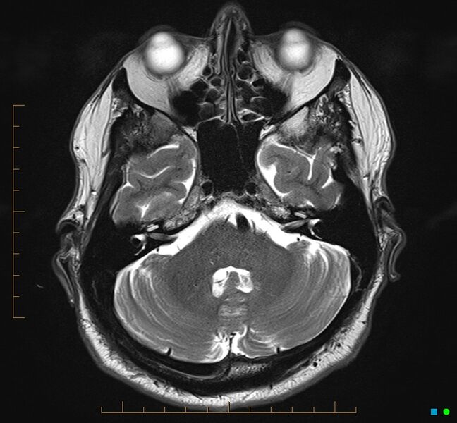 File:Cerebellar gangliocytoma (Radiopaedia 65377-74422 Axial T2 9).jpg