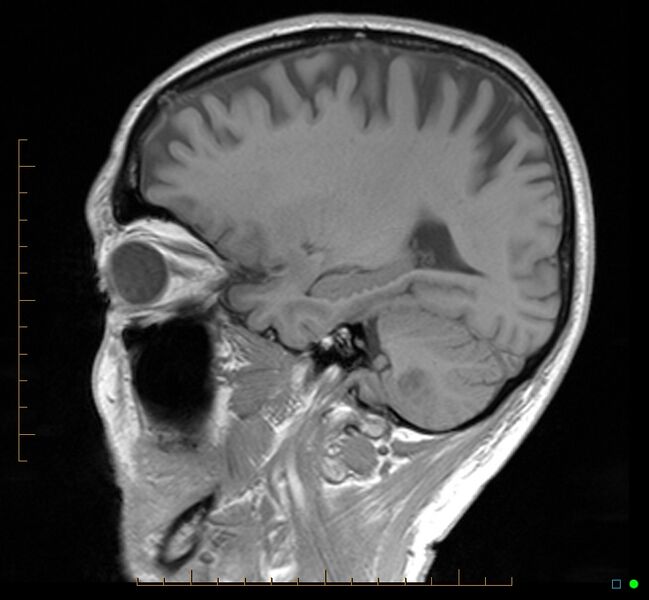 File:Cerebellar gangliocytoma (Radiopaedia 65377-74422 Sagittal T1 13).jpg