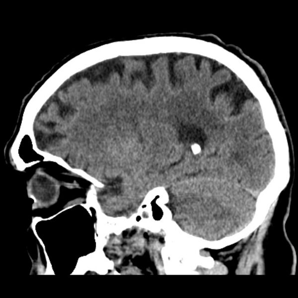 File:Cerebellar hemorrhage (Radiopaedia 27193-27359 C 16).jpg