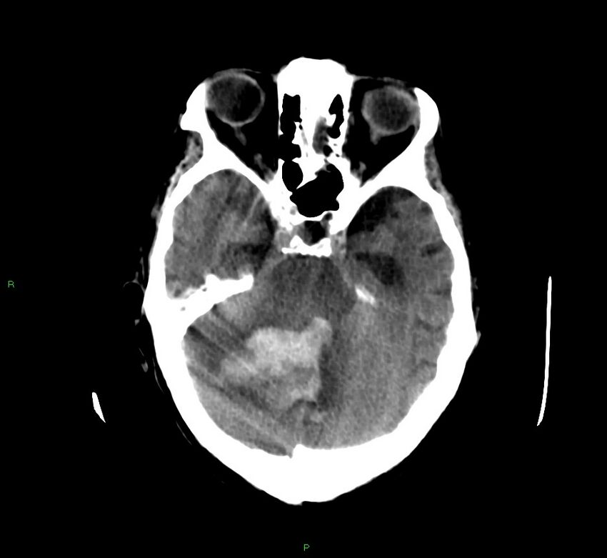 Cerebellar hemorrhage (Radiopaedia 58792-66026 Axial non-contrast 35).jpg