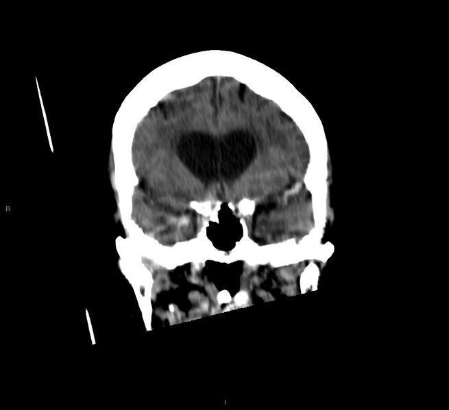 File:Cerebellar hemorrhage (Radiopaedia 58792-66026 Coronal non-contrast 42).jpg