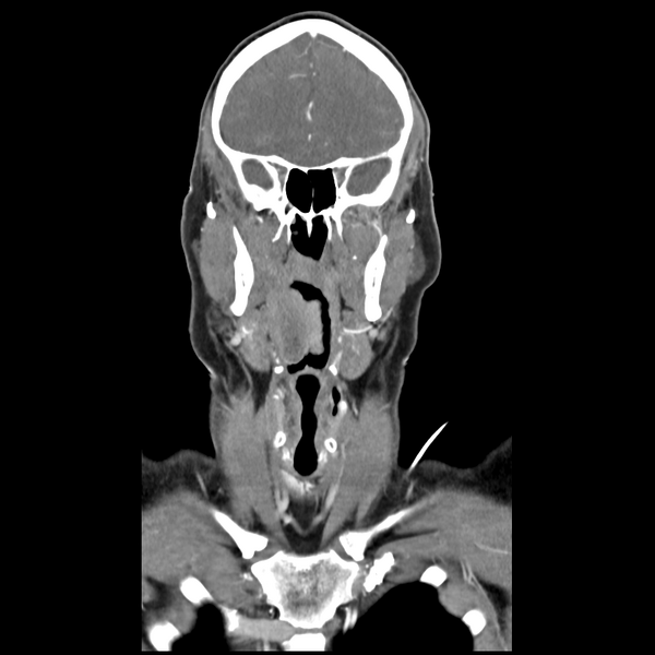 File:Cerebellar infarct due to vertebral artery dissection with posterior fossa decompression (Radiopaedia 82779-97029 D 20).png