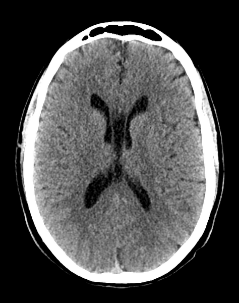 File:Cerebellar infarct due to vertebral artery dissection with posterior fossa decompression (Radiopaedia 82779-97033 Axial non-contrast 21).png