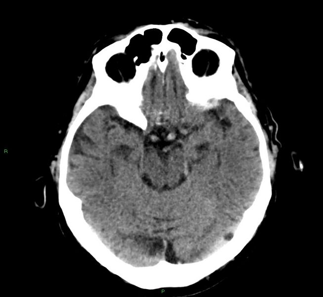 File:Cerebral amyloid angiopathy-associated lobar intracerebral hemorrhage (Radiopaedia 58376-65511 Axial non-contrast 37).jpg