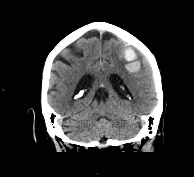 File:Cerebral amyloid angiopathy-associated lobar intracerebral hemorrhage (Radiopaedia 58376-65511 Coronal non-contrast 24).jpg