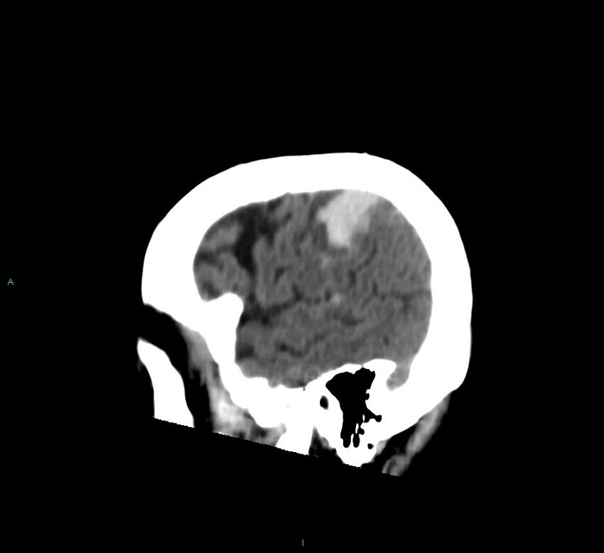 Cerebral amyloid angiopathy-associated lobar intracerebral hemorrhage (Radiopaedia 58376-65513 C 20).jpg