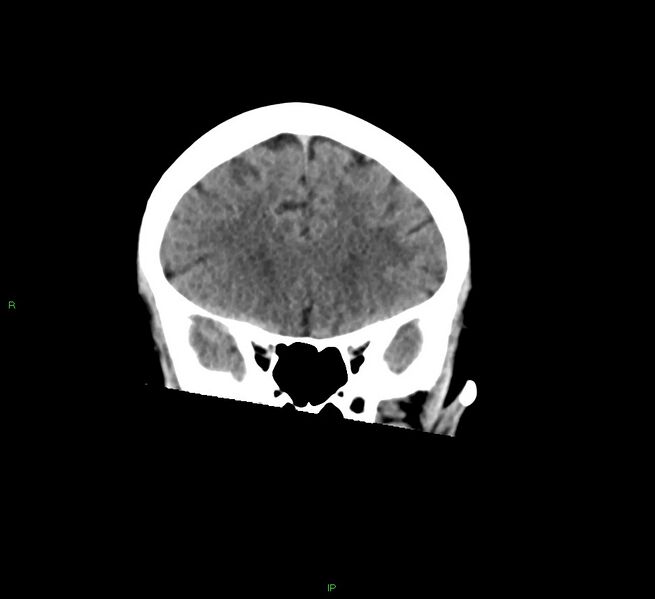 File:Cerebral amyloid angiopathy-associated lobar intracerebral hemorrhage (Radiopaedia 58378-65516 Coronal non-contrast 44).jpg