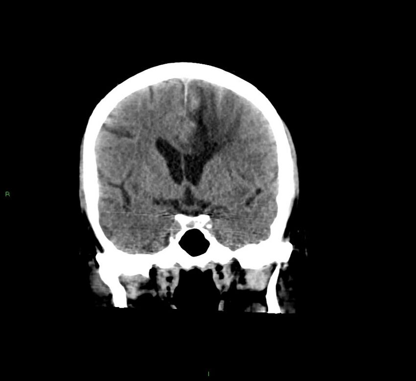 Cerebral amyloid angiopathy-associated lobar intracerebral hemorrhage (Radiopaedia 58529-65681 Coronal non-contrast 40).jpg