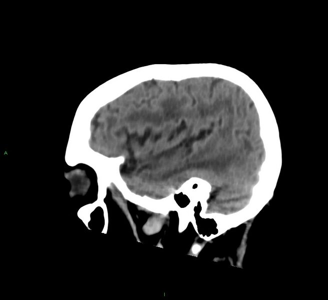 File:Cerebral amyloid angiopathy-associated lobar intracerebral hemorrhage (Radiopaedia 58530-65688 C 13).jpg