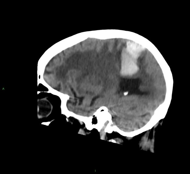 File:Cerebral amyloid angiopathy-associated lobar intracerebral hemorrhage (Radiopaedia 58530-65688 C 38).jpg