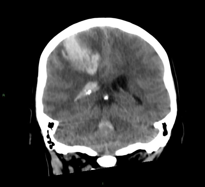 File:Cerebral amyloid angiopathy-associated lobar intracerebral hemorrhage (Radiopaedia 58566-65730 Coronal non-contrast 29).jpg