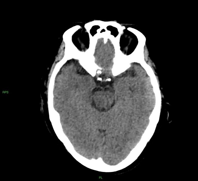 File:Cerebral amyloid angiopathy-associated lobar intracerebral hemorrhage (Radiopaedia 58569-65734 Axial non-contrast 40).jpg