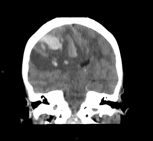 File:Cerebral amyloid angiopathy-associated lobar intracerebral hemorrhage (Radiopaedia 58751-65972 Coronal non-contrast 32).jpg