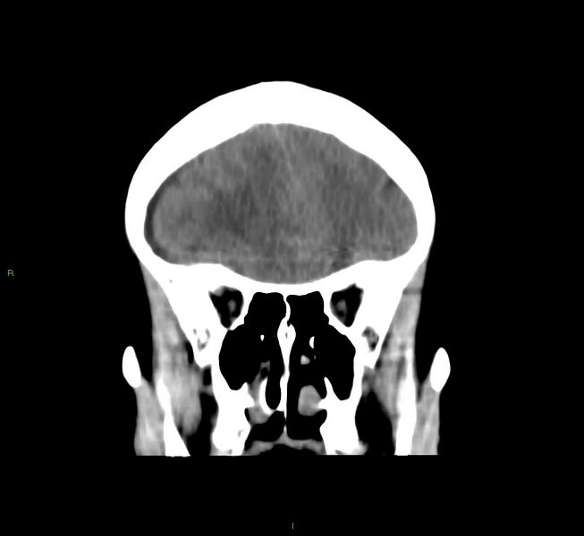 File:Cerebral amyloid angiopathy-associated lobar intracerebral hemorrhage (Radiopaedia 58751-65972 Coronal non-contrast 46).jpg