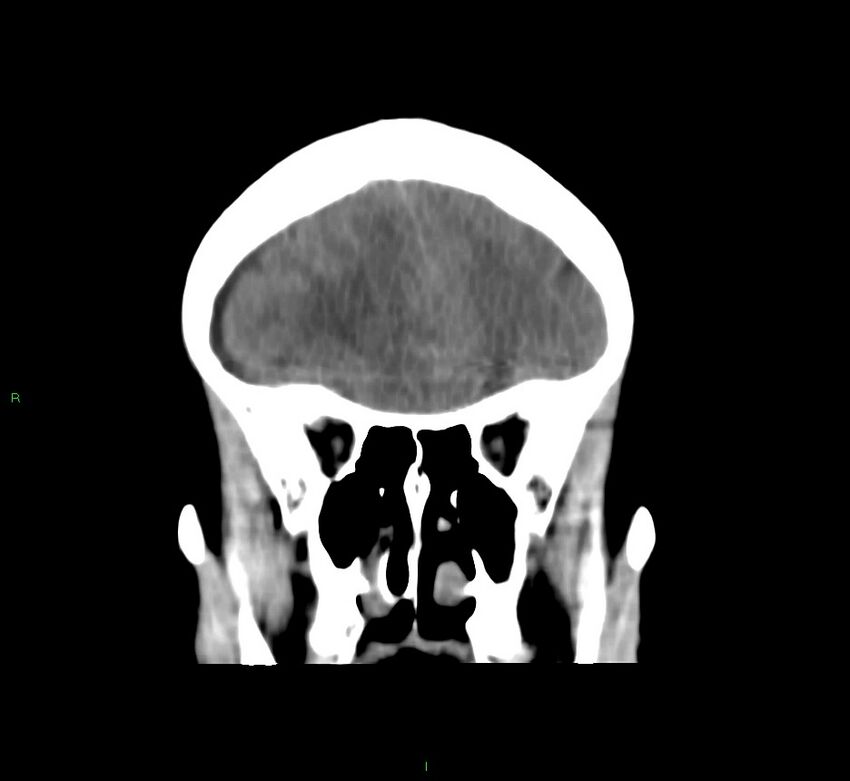 Cerebral amyloid angiopathy-associated lobar intracerebral hemorrhage (Radiopaedia 58751-65972 Coronal non-contrast 46).jpg