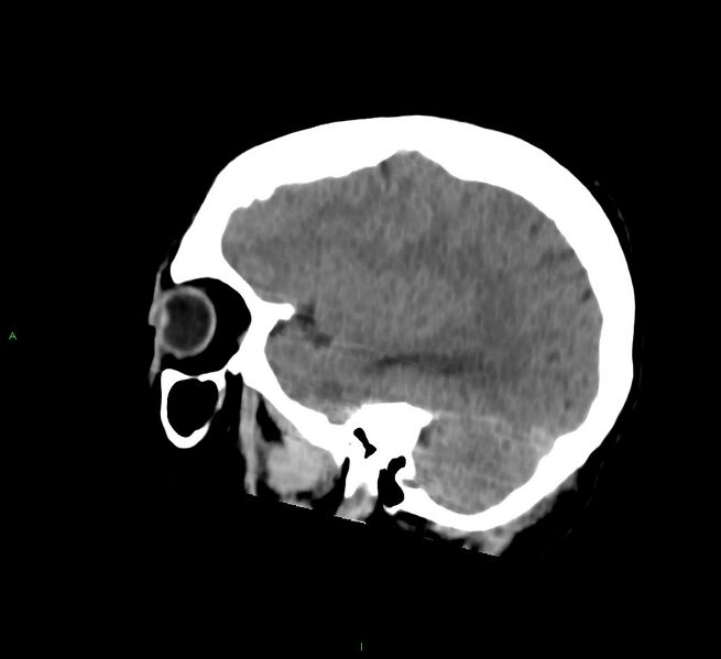 File:Cerebral amyloid angiopathy-associated lobar intracerebral hemorrhage (Radiopaedia 58756-65977 C 43).jpg