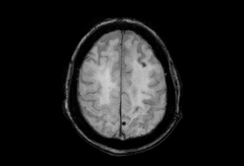 File:Cerebral amyloid angiopathy (Radiopaedia 86671-102792 Axial Gradient Echo 12).jpg