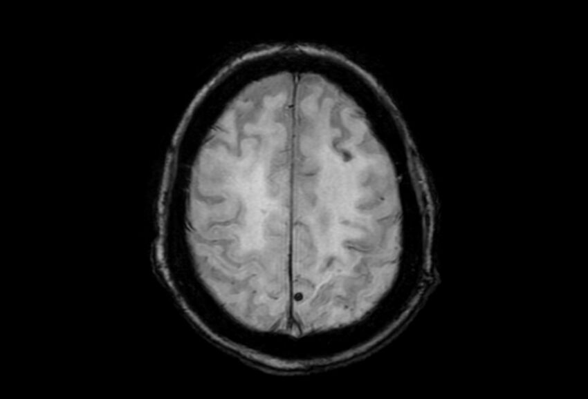 Cerebral amyloid angiopathy (Radiopaedia 86671-102792 Axial Gradient Echo 12).jpg