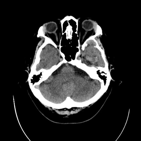 File:Cerebral arteriovenous malformation (Radiopaedia 43729-47189 Axial non-contrast 8).jpg