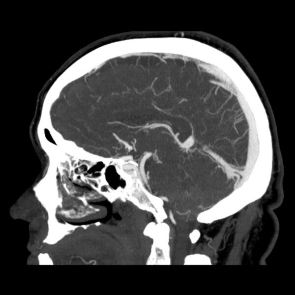 File:Cerebral arteriovenous malformation (Radiopaedia 43729-47189 D 22).jpg