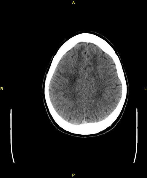 File:Cerebral autosomal dominant arteriopathy with subcortical infarcts and leukoencephalopathy (CADASIL) (Radiopaedia 86108-102051 Axial non-contrast 84).jpg