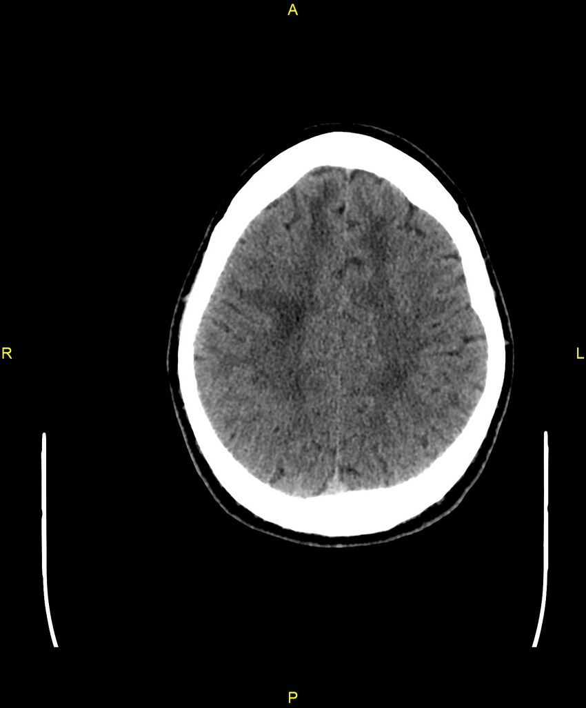 Cerebral autosomal dominant arteriopathy with subcortical infarcts and leukoencephalopathy (CADASIL) (Radiopaedia 86108-102051 Axial non-contrast 84).jpg