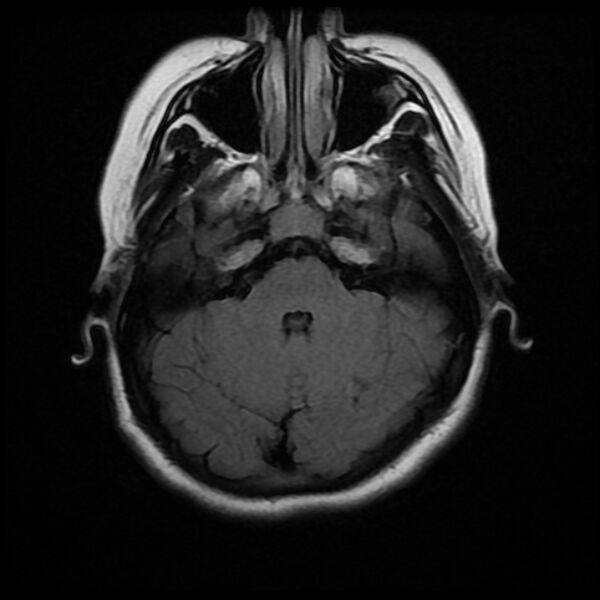 File:Cerebral cavernous malformation (Radiopaedia 44301-47942 Axial FLAIR 6).jpg