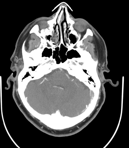 File:Cerebral dural venous sinus thrombosis (Radiopaedia 86514-102576 A 36).jpg