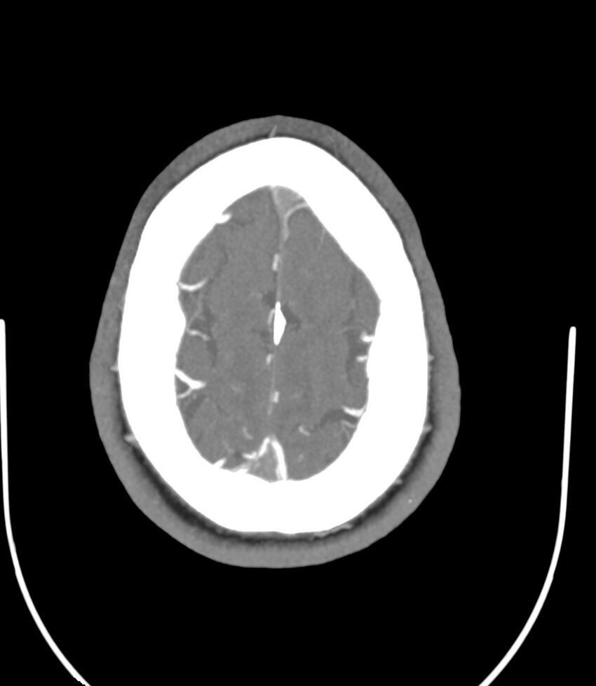 Cerebral dural venous sinus thrombosis (Radiopaedia 86514-102576 A 83).jpg